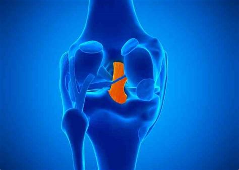 PCL Injury | Posterior Cruciate Ligament | Orthopedic Knee Specialist ...