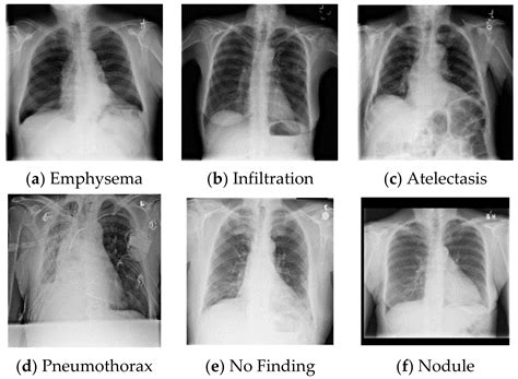 Anatomy Of Chest X Ray : Normal Chest Xray Stock Photo Download Image ...