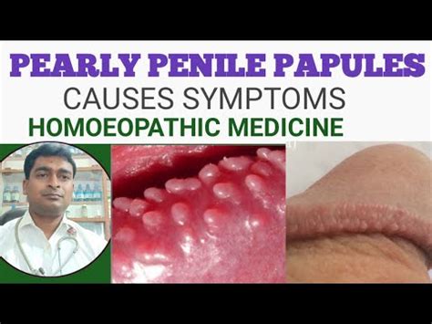 Pearly penile papules causes symptoms and it's Homoeopathic medicine ...