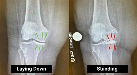 The importance of a standing knee X-ray to evaluate arthritis | Steve ...