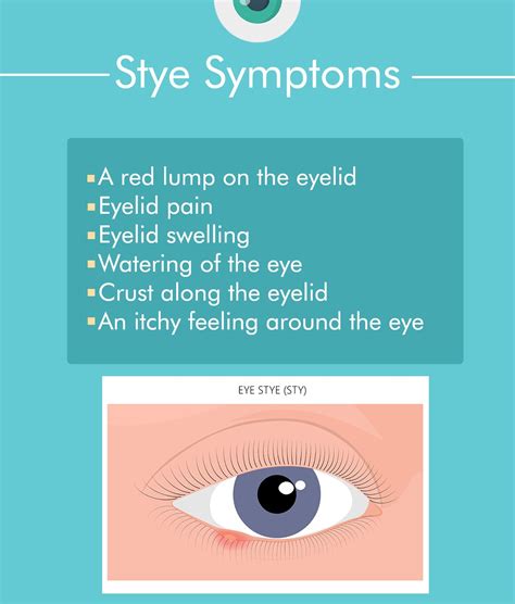 Got a Stye in Your Eye? Causes and Treatments of Styes – The Amino Company