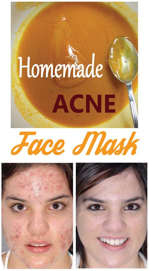 Homemade Acne Face Mask ~ Weight Loss - Lose Weight Fast With Diet Tips ...