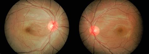 Cureus | Central Retinal Artery Occlusion with Sparing of Cilioretinal ...