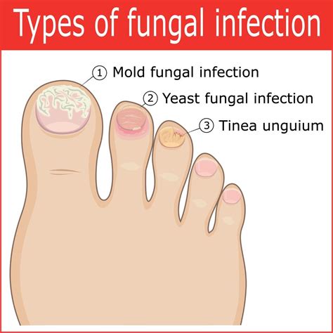 toenail fungus drug - Toenail Fungus Treatment | Toenail Fungus Treatment