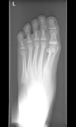 X Ray Broken Toe