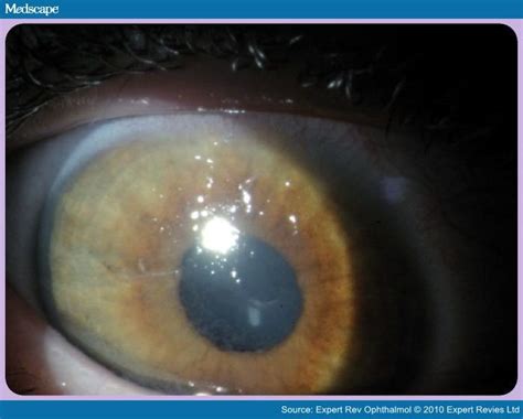 Cornea Problems - Net Health Book