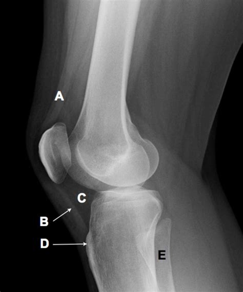 Lateral radiograph of the knee | The BMJ