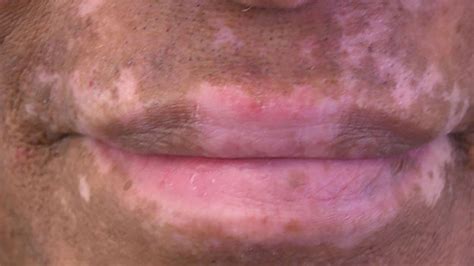 Hypopigmentation: What Causes It And How Is It Treated?, 45% OFF