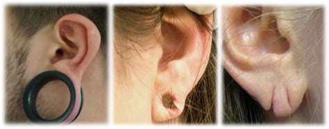 Torn and stretched ear lobe repairs - Kingsley Medical | More than your ...