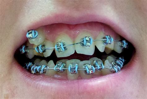 Dental Care: Braces For Adults