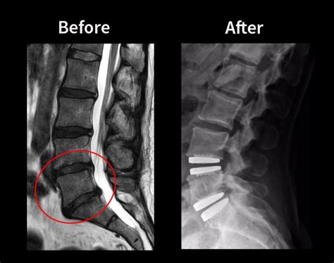 Disc Replacement Surgery - Procedure, Risks & Recovery - Neuroaxis