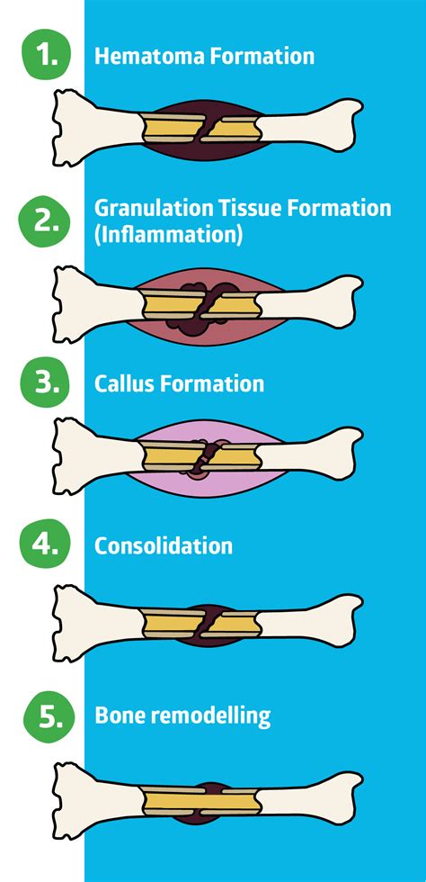 Bone Fracture Healing Supplements - Do They Work? | AlgaeCal