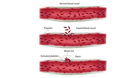 Factor IV (Calcium) Coagulation Blood Test