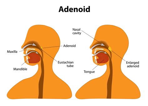 Tonsils and Adenoids - North Dallas ENT