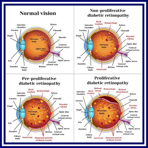 Diabetic Eye Problems – Information, Treatment, Prevention, A Guide