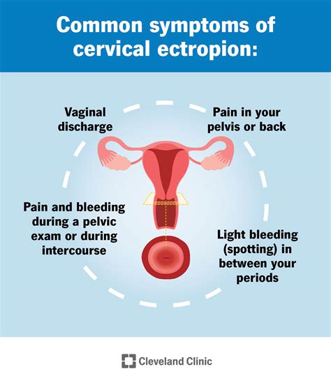 Cervical Ectropion: Causes, Symptoms & Treatment