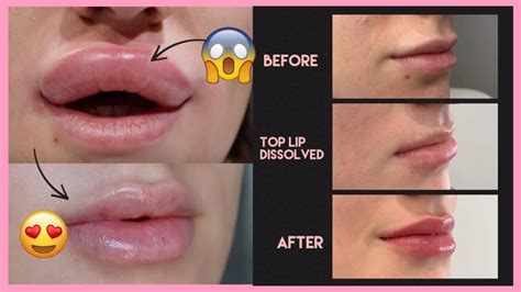 How Much Do Lips Swell After Filler | Lipstutorial.org