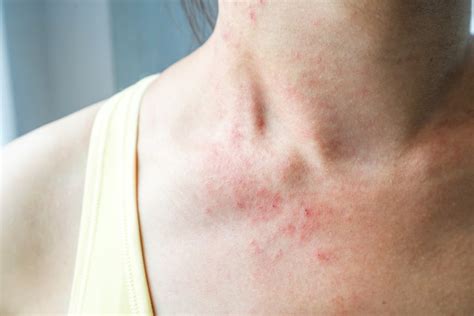 What is A Heat Rash, a Sweat Rash, or a Photosensitivity Rash?