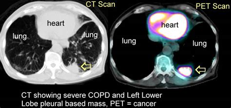 Xrays and CT Scans of Lung Cancer