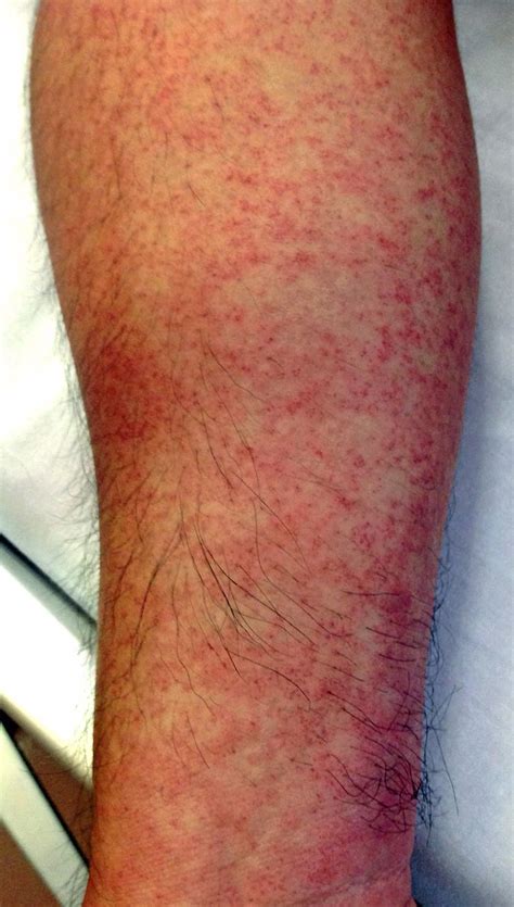 Skin rash from dengue fever | BMJ Case Reports