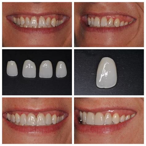 Smile Spotlight: Amy | Love Your Smile with Porcelain Veneers