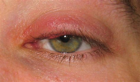 Stye Eye - Causes, Symptoms, Pictures, Treatment, Prevention | Diseases ...