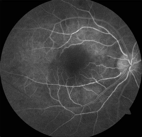 Cilioretinal Artery Occlusion