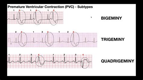 Premature Ventricular Contractions Vs Pac Images And Photos Finder ...