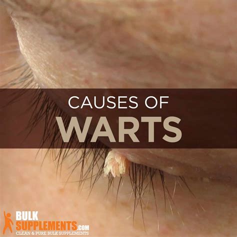 Warts: Causes, Symptoms, Characteristics & Treatment