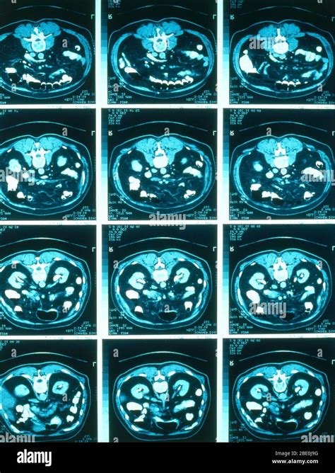 Normal Ct Scan Abdomen