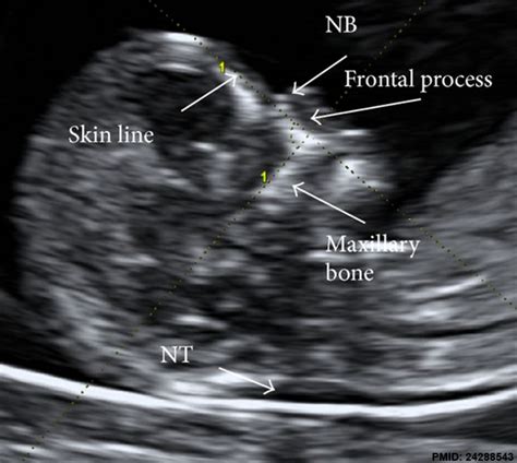 File:Ultrasound nuchal translucency.jpg - Embryology