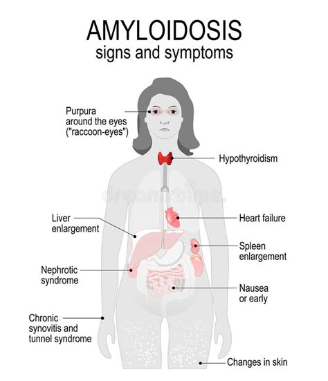 Amyloidosis. Signs and Symptoms. Stock Vector - Illustration of ...