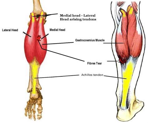 Medial gastrocnemius strain causes, symptoms, diagnosis, treatment ...