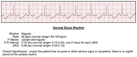 Normal Sinus Rhythm - ACLS Wiki