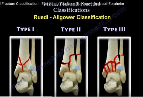 Tibial Plafond fracture Classification — OrthopaedicPrinciples.com