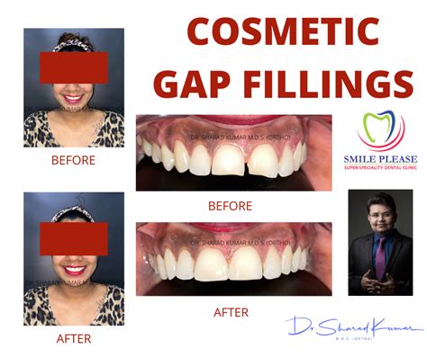 Treatment of Gaps in Front Teeth | Vashi| Dentist Near Me | INVISALIGN