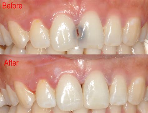 Before and After 5 | Burpengary Dental