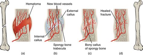 This illustration shows a left to right progression of bone repair. The ...