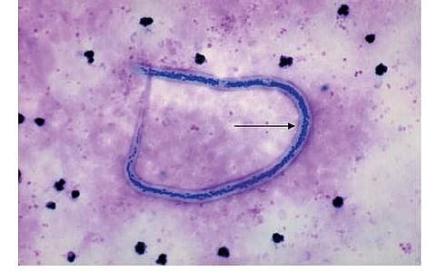 Elephantiasis and Lymphatic Filariasis: Causes, Symptoms, Treatment and ...