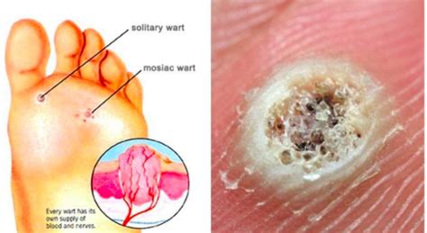 Plantar Wart – The Podiatry Experts