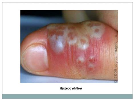 PPT - COMMON SKIN INFECTIONS PowerPoint Presentation - ID:265856