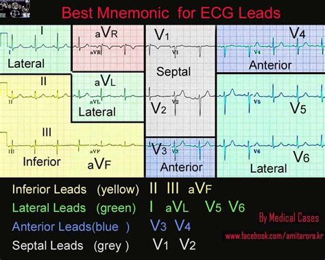 12 lead ecg interpretation made easy