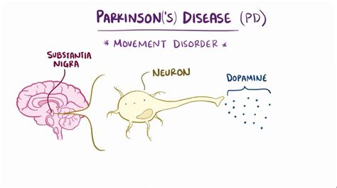 Dysarthria: What Is It, Causes, Signs, and More | Osmosis