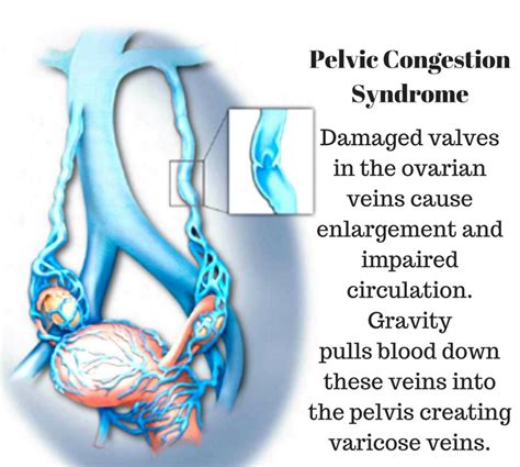 What is Pelvic Venous Congestion Syndrome? (Failures Observed in ...