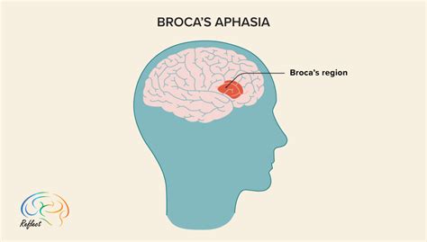 Broca's Aphasia