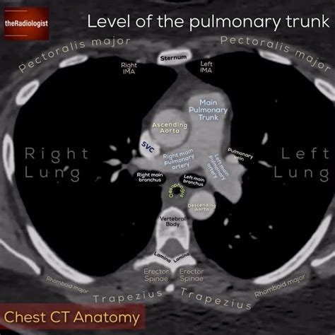 Check out this video clip of a CT chest with annotated stills at four ...