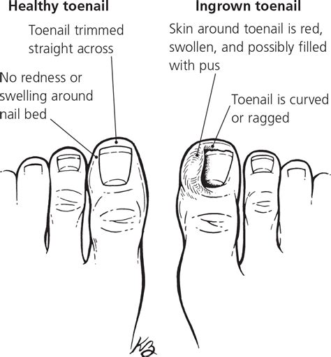 Mild Ingrown Toenail