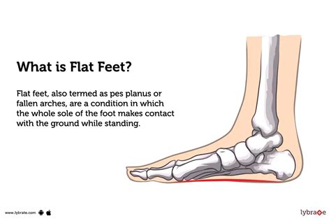 Flat Feet: Causes, Symptoms, Treatment and Cost