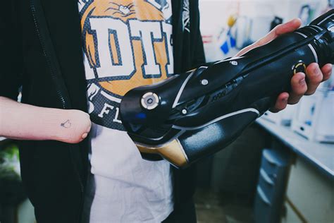 Bionic Arm Prosthetics