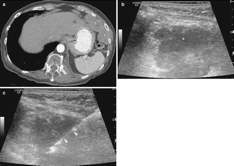 Pleural Biopsy | Radiology Key